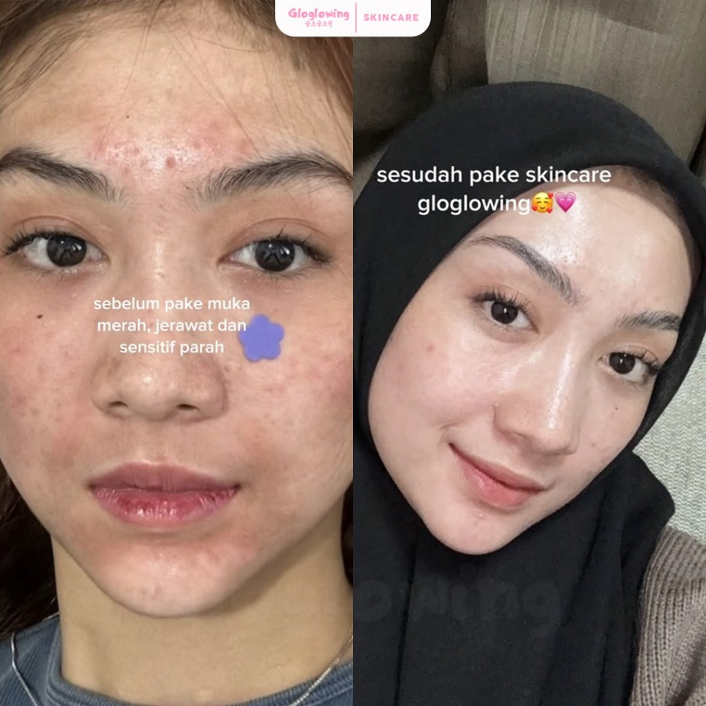 GLOGLOWING Day + Night Acne