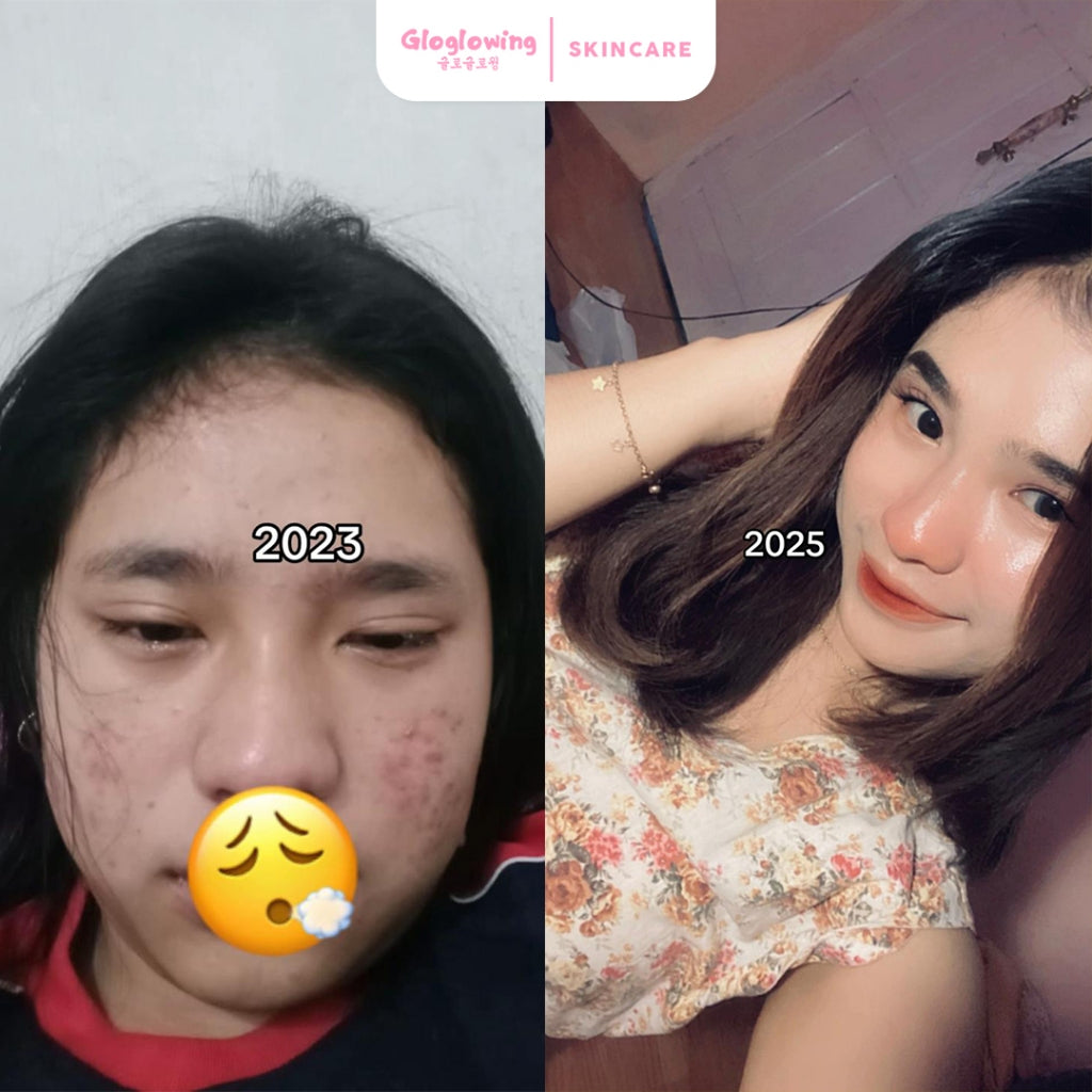 GLOGLOWING Glowing Night Acne Booster 10g