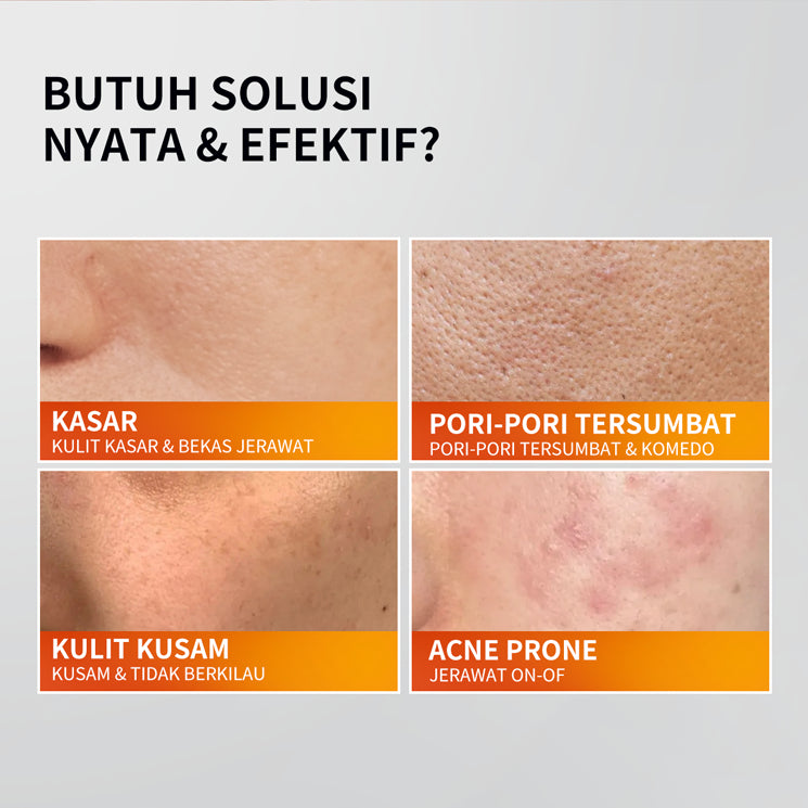 PREMIERE BEAUTE [NEW LAUNCH] [DAPAT 2] AHA BHA PHA 18% Triple Acids Advanced Peeling Ampoule REAL & EFFECTIVE High Dose Exfoliation ZERO OXIDATION Pore Refining