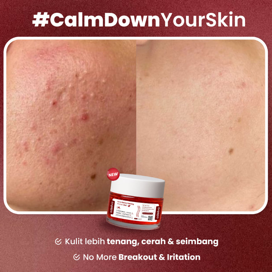 ADLEEVA - Revive Calming Moist Gel - Bantu menenangkan kulit berjerawat, Dermatitis, Breakout, Purging Serta Meredakan Kemerahan
