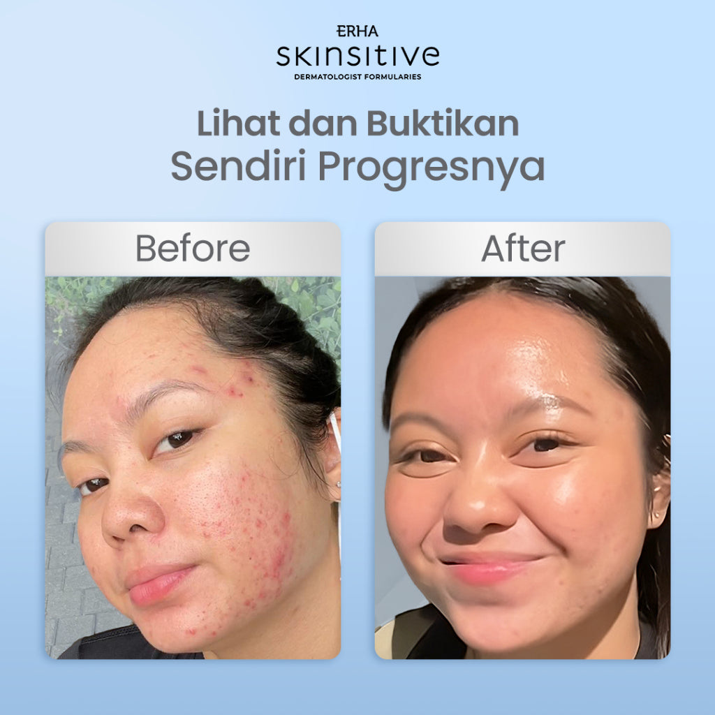 ERHA Skinsitive Ultracalm Face Serum 30g | Serum untuk Memperkuat Skin Barrier | Menenangkan Kulit Sensitif, Kemerahan, Iritasi, Breakout | Mengandung Calming Agent & Moisturizing | Mengandung Panthenol, Vitamin E