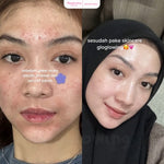GLOGLOWING Glowing Night Acne Booster 10g
