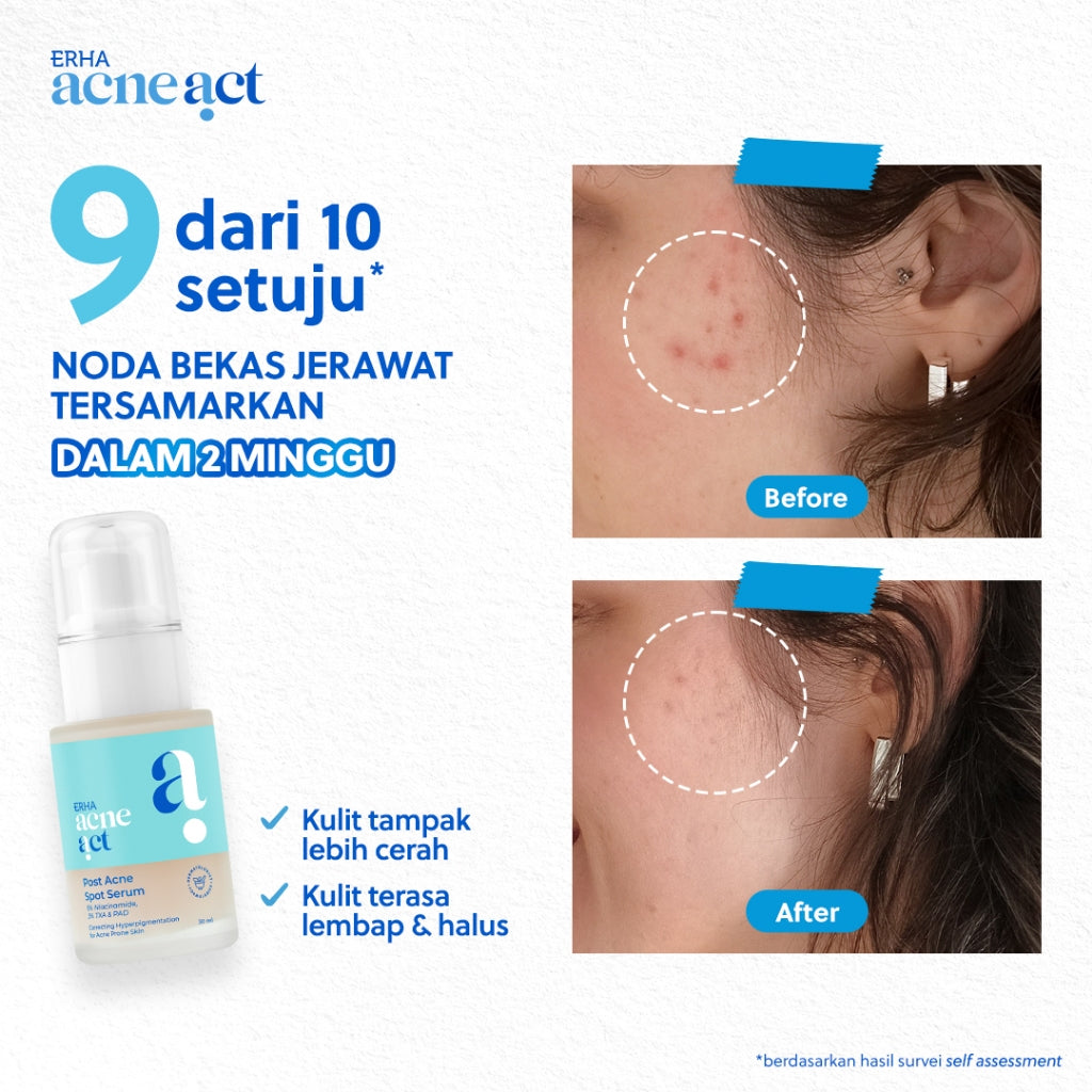 ERHA Acneact Post Acne Spot Serum 30ml - Serum Bekas Jerawat | Tranexamic Acid | Niacinamide
