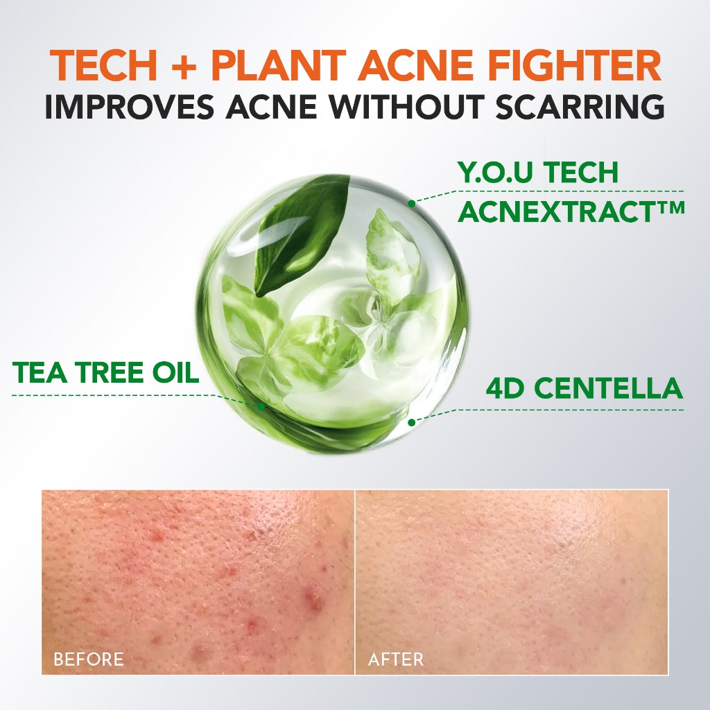 [NEW] YOU AcnePlus 2% BHA Fight Acne Serum Jerawat Kulit Berminyak Berjerawat Salicylic Acid Serum