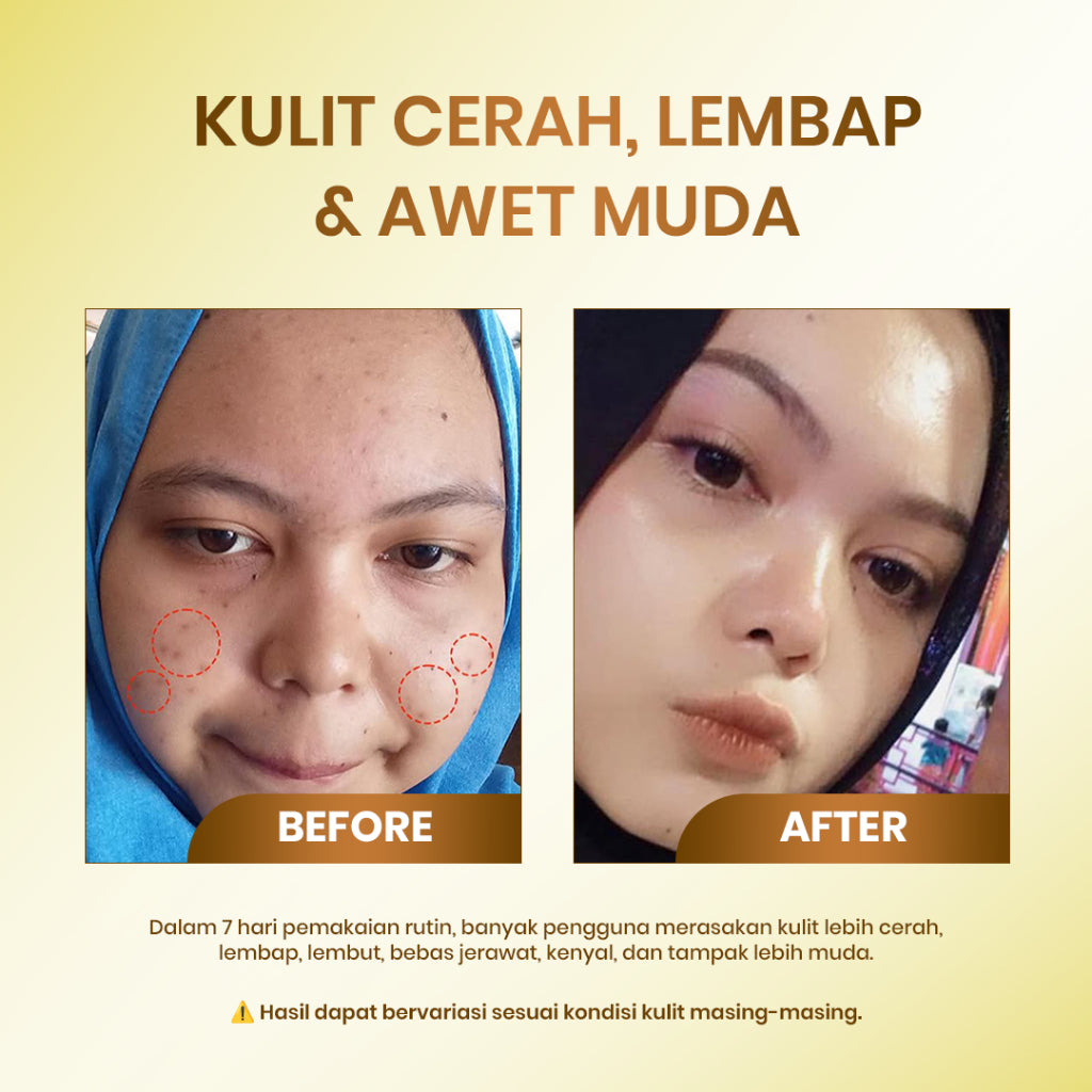 [ ] Cleora Glowing Set Special Bundle 2in1 - Exclusive Glow Jelly Booster Vit C + Red Saviour Eksfoliasi Serum Peeling Solution Exfoliasi Wajah Moisturizer Paket Scincare Pria Dan Wanita Mencerahkan Mosturizer Skincare Dark Spot Acne Niacinamide