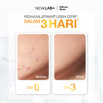 NEWLAB Acnalogy Powder Drink | Acne Drink | Minuman Obat Jerawat untuk Meredakan Bekas Jerawat dan Flek Hitam BPOM 15 Sachet