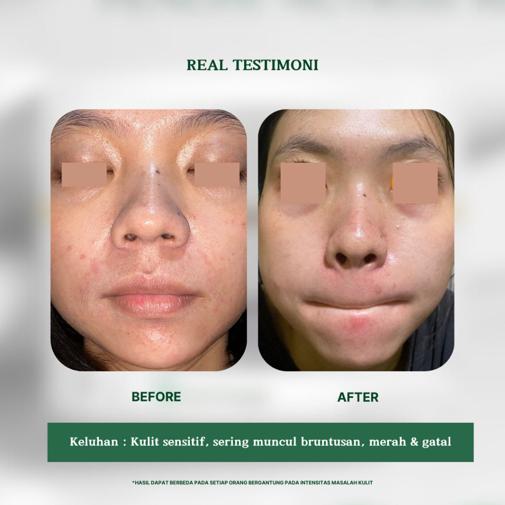 Personal Beauty Acne Soothing Cream - Soothing And Calming