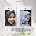 Jglow Skincare Paket Kulit Berjerawat Acne (Perawatan Kulit Bejerawat) - 4pcs