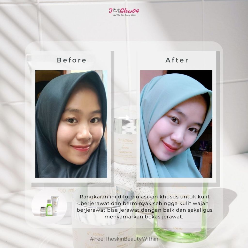 Jglow Skincare Paket Kulit Berjerawat Acne (Perawatan Kulit Bejerawat) - 4pcs