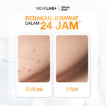 NEWLAB Acnalogy Acne Gel | Obat Totol Jerawat | Salep untuk Jerawat |Meredakan Acne Spot dan Bekasnya 15gr