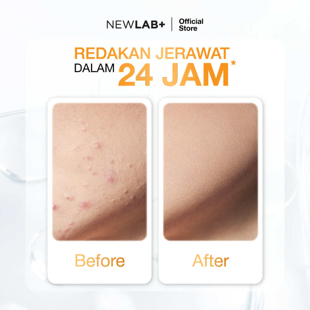 NEWLAB Acnalogy Acne Gel | Obat Totol Jerawat | Salep untuk Jerawat |Meredakan Acne Spot dan Bekasnya 15gr