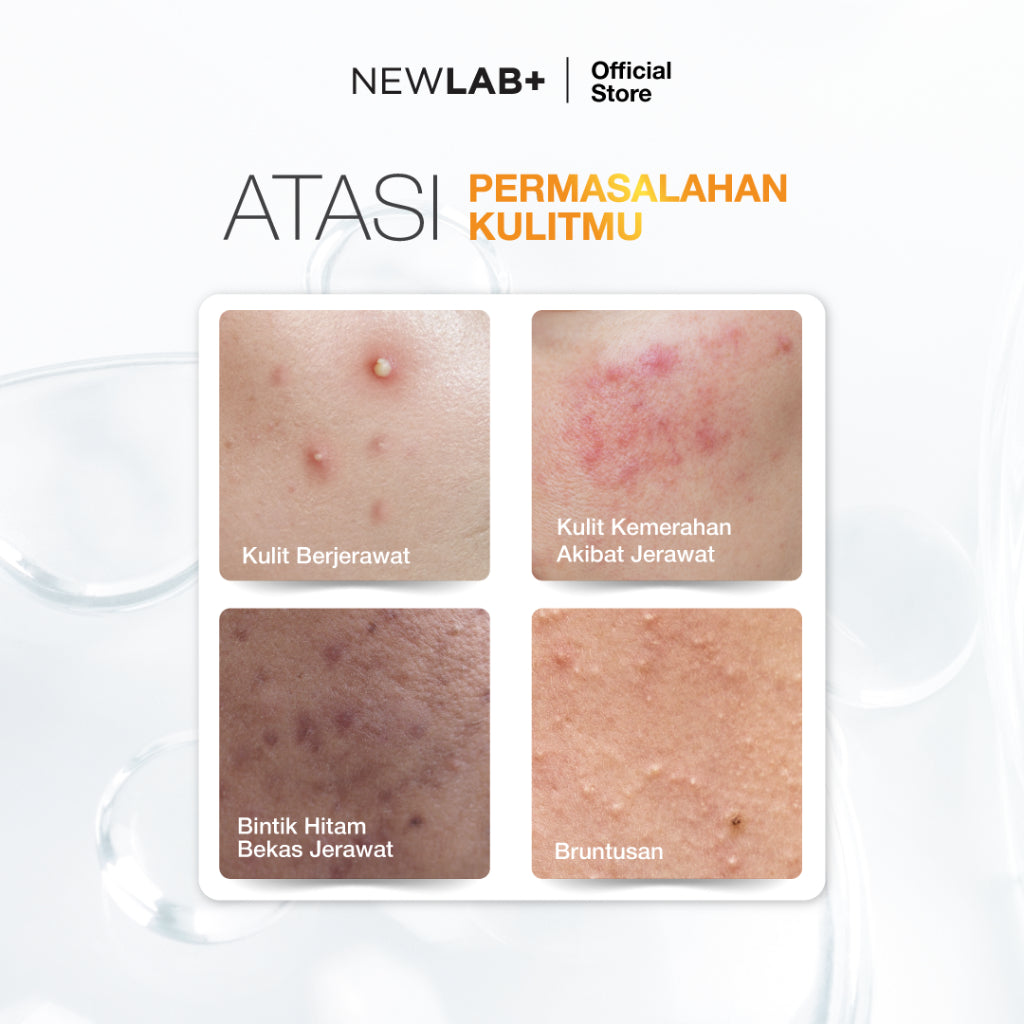 NEWLAB Acnalogy Acne Gel | Obat Totol Jerawat | Salep untuk Jerawat |Meredakan Acne Spot dan Bekasnya 15gr
