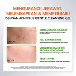 YOU AcnePlus Gentle Gel Cleanser Sabun Cuci Muka Jerawat Kulit Berminyak Berjerawat Salicylic Acid Face Wash