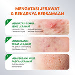 [NEW UPGRADED] YOU AcnePlus Spot Care Pro Serum Obat Totol Jerawat B5 Barrier Moisturizer Gel Obat Bekas Jerawat Kulit Sensitif Kulit Berjerawat [Hot Selling]