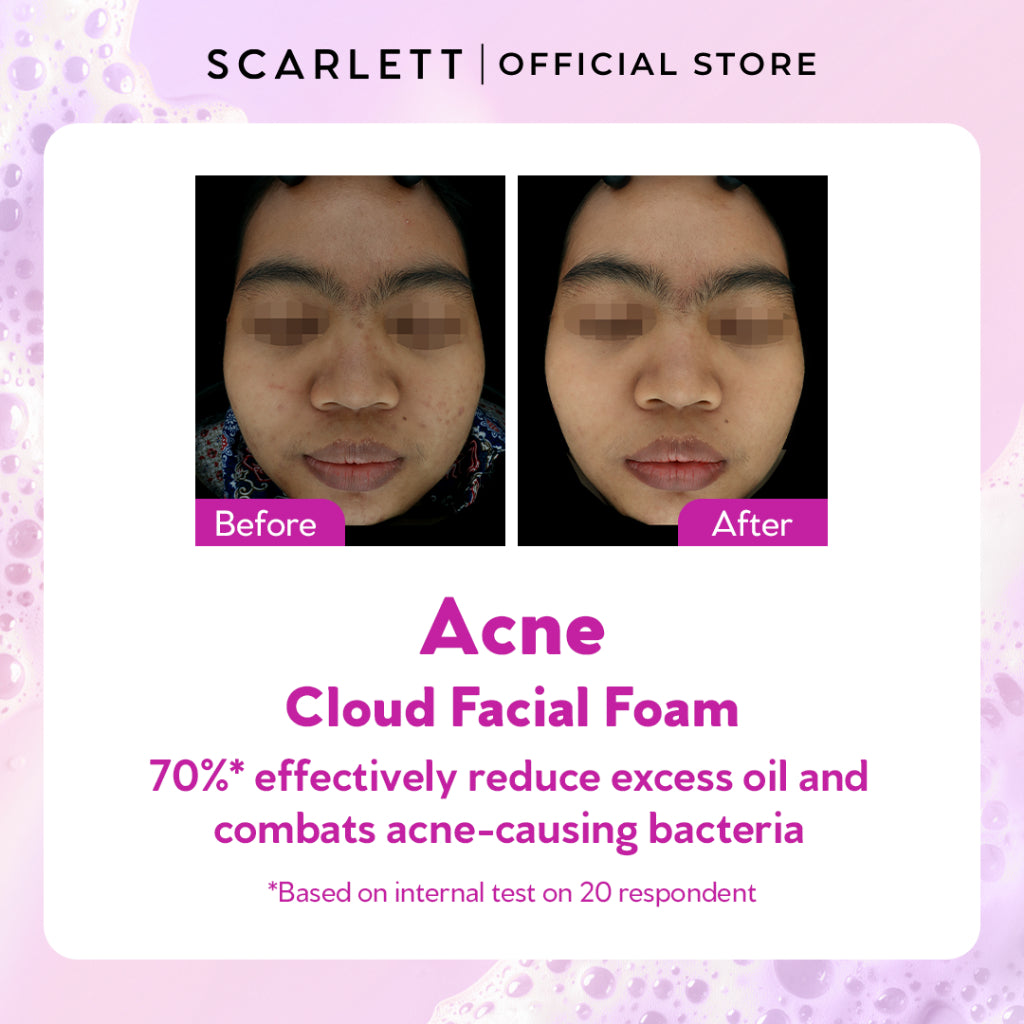 Scarlett Whitening Acne Cloud Facial Foam