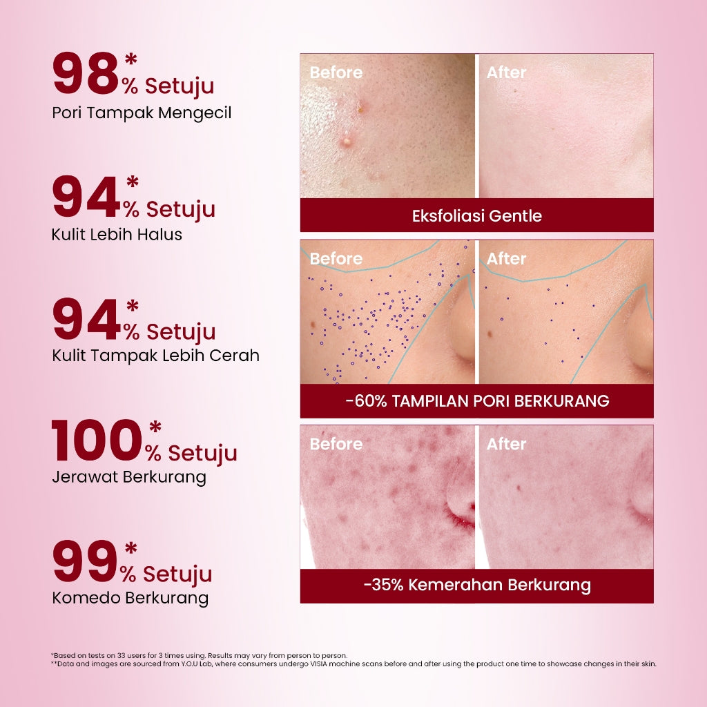 YOU 6% ACID RENEWAL PEELING SERUM AHA BHA PHA Serum Eksfoliasi Untuk Kulit Cerah dan Halus