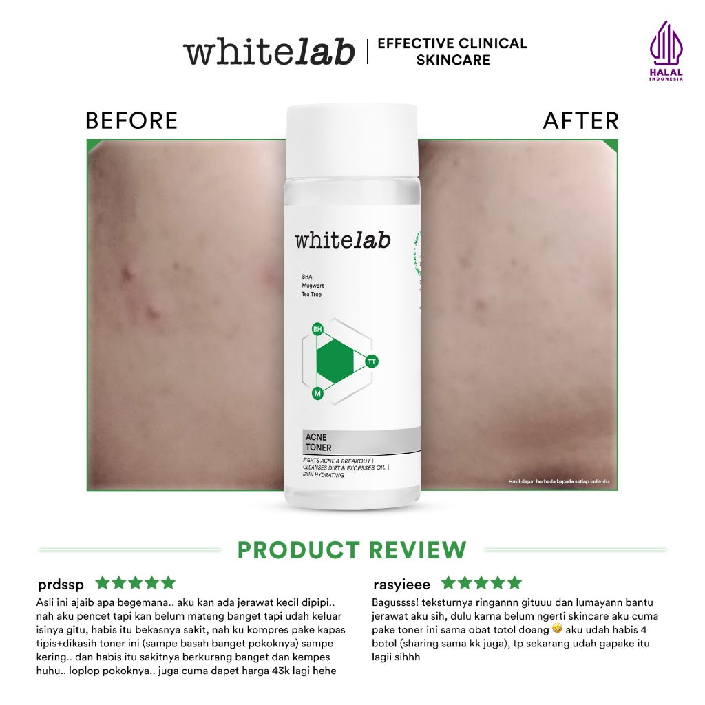 Whitelab Acne Toner - Toner Untuk Kulit Jerawat Menenangkan dan Mengontrol Minyak Berlebih dengan Bha, Mugwort & Tea Tree [BPOM]