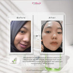 Jglow Skincare Paket Kulit Berjerawat Acne (Perawatan Kulit Bejerawat) - 4pcs