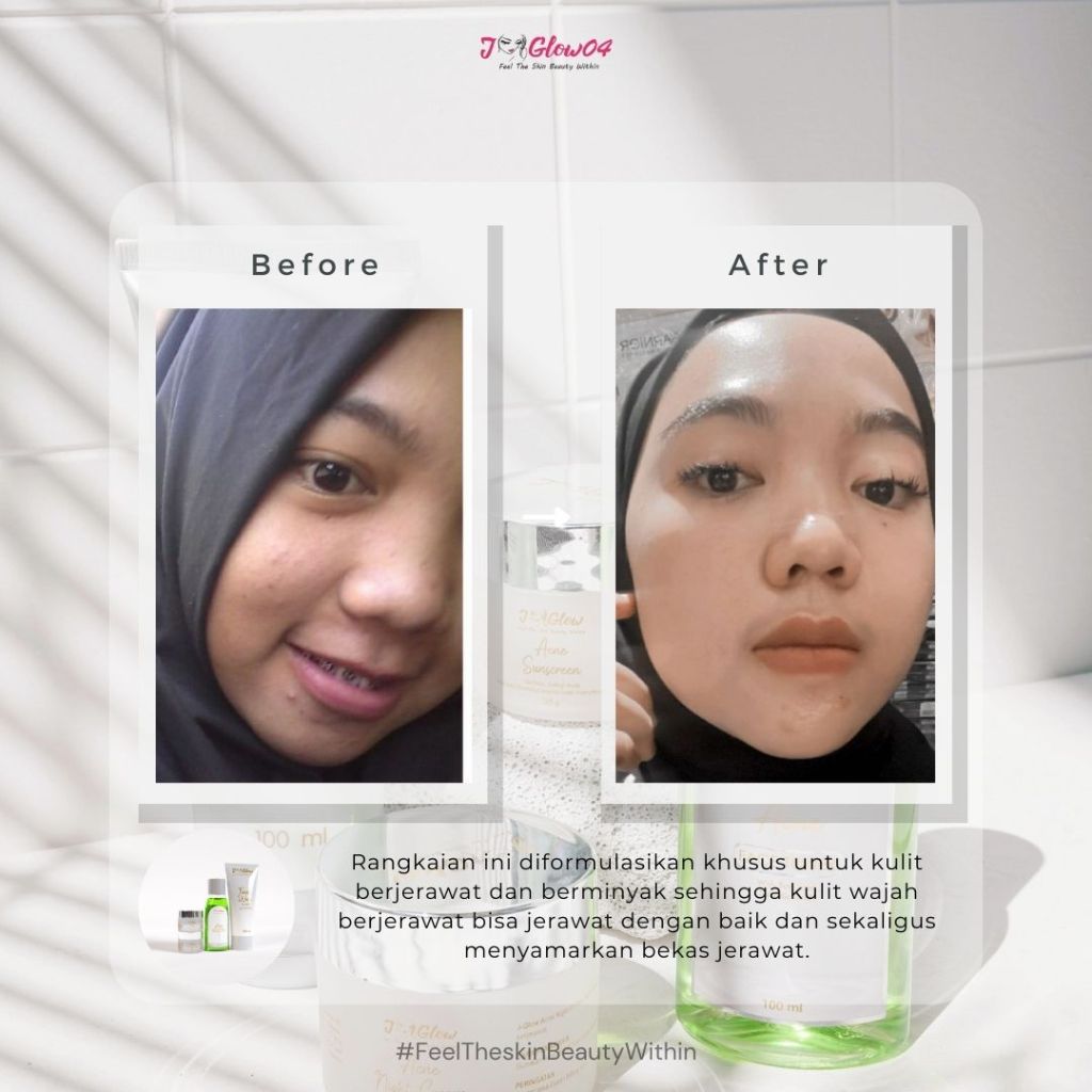 Jglow Skincare Paket Kulit Berjerawat Acne (Perawatan Kulit Bejerawat) - 4pcs