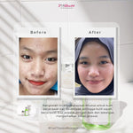 Jglow Skincare Paket Kulit Berjerawat Acne (Perawatan Kulit Bejerawat) - 4pcs