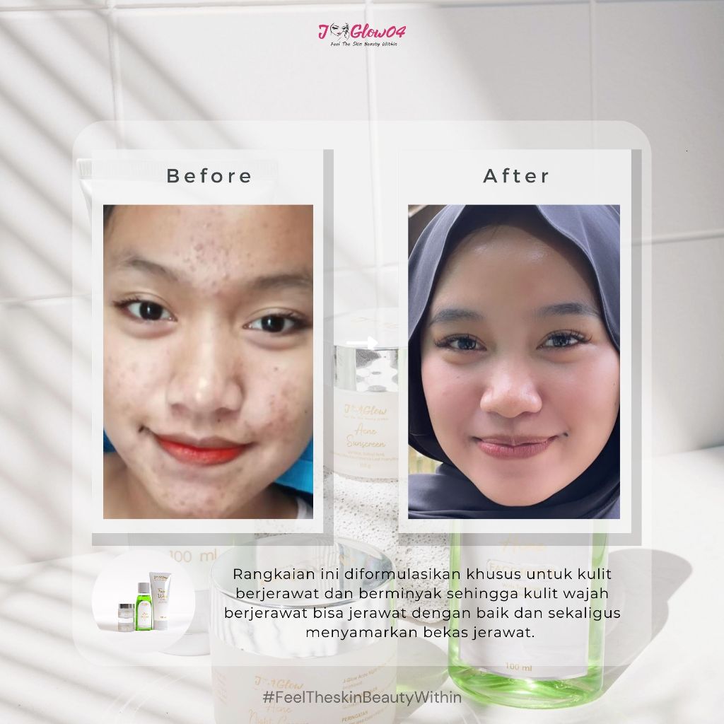 Jglow Skincare Paket Kulit Berjerawat Acne (Perawatan Kulit Bejerawat) - 4pcs