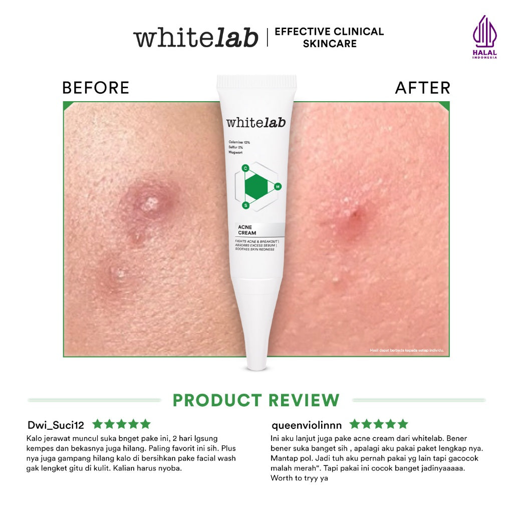Whitelab Acne Cream - Krim Totol Atasi Jerawat dalam 2 Hari dengan Sulfur, Calamine & Mugwort [BPOM]