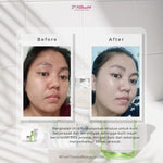 Jglow Skincare Paket Kulit Berjerawat Acne (Perawatan Kulit Bejerawat) - 4pcs