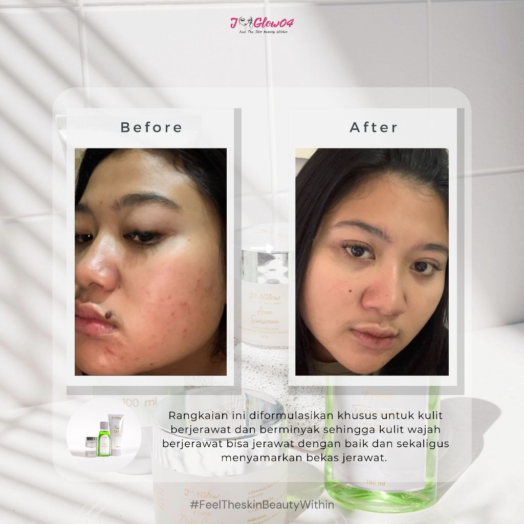 Jglow Skincare Paket Kulit Berjerawat Acne (Perawatan Kulit Bejerawat) - 4pcs