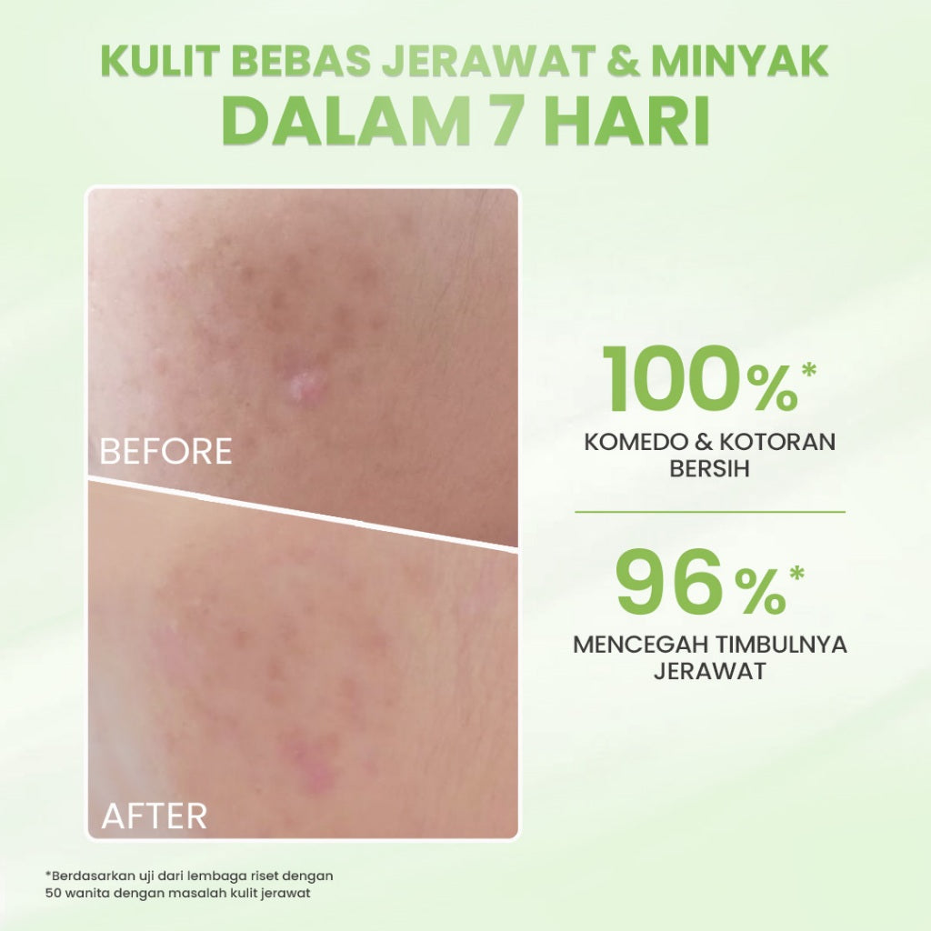 Hanasui Acne Expert Gentle Cleanser  Sabun Busa Lembut Mengurangi Jerawat Tanpa Rasa Ketarik - Salicylic Acid Centella Panthenol