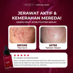 [CREATOR] [Abel Cantika's Picks] Lacoco Grape Fruit Acne Fighter Serum Skincare Jerawat Meradang Beruntusan Glow Swiss Glad Skint