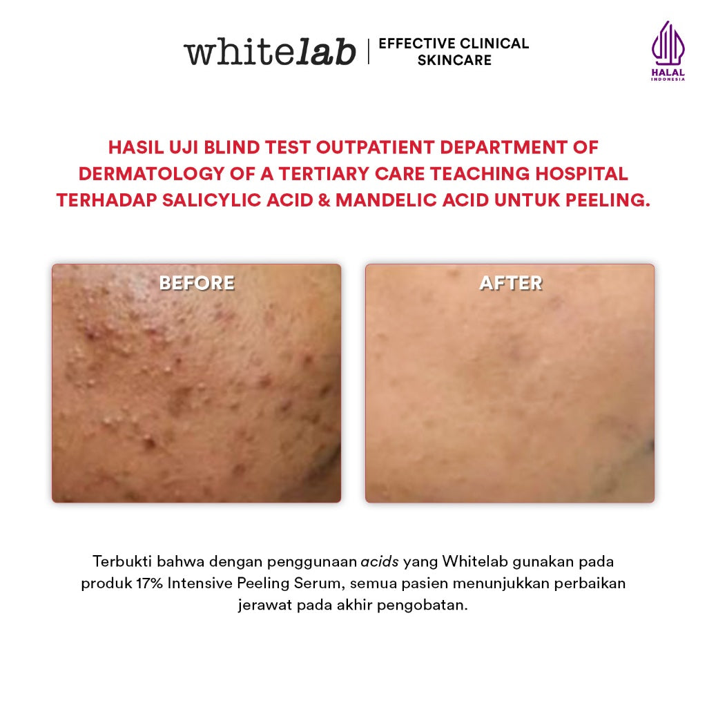 Whitelab 17% Intensive Peeling AHA BHA PHA Serum - Serum Eksfoliasi Pengangkat Sel Kulit Mati Memperbaiki Tekstur Kulit Sebum Melting Komedo [BPOM]
