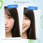 MS GLOW ACNE ZONE BB PREMIUM
