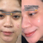 ADLEEVA Night Cream Acne Fighter & Glow Power