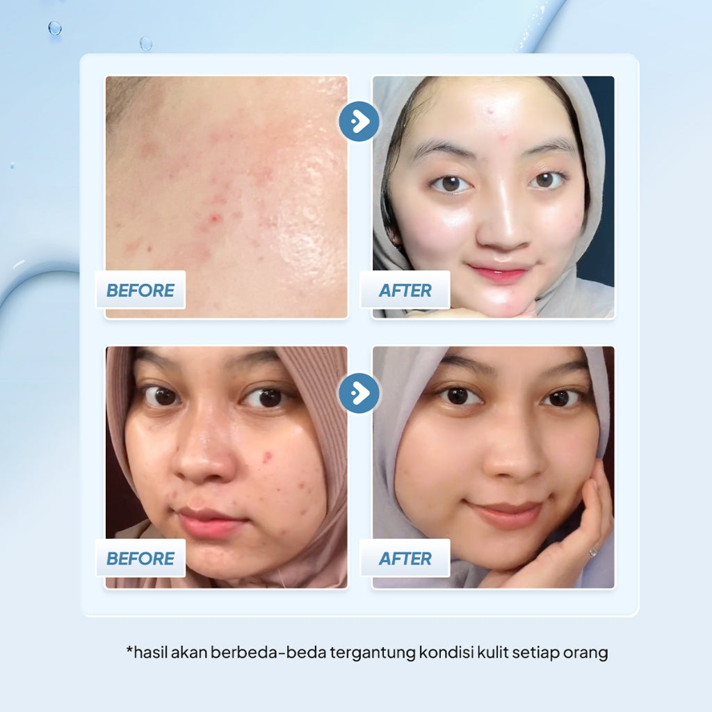 Implora 8+ Ceramide Skin Barrier Moisturizing Gel | Pelembab Kulit Kering, Kombinasi, Acne Prone | Moisturizer Sensitive Skin