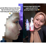 ADLEEVA Paket Hemat Acne Bright Series "COMPLETE" (Paket Isi 5 - Free Acne Blemish Spot)