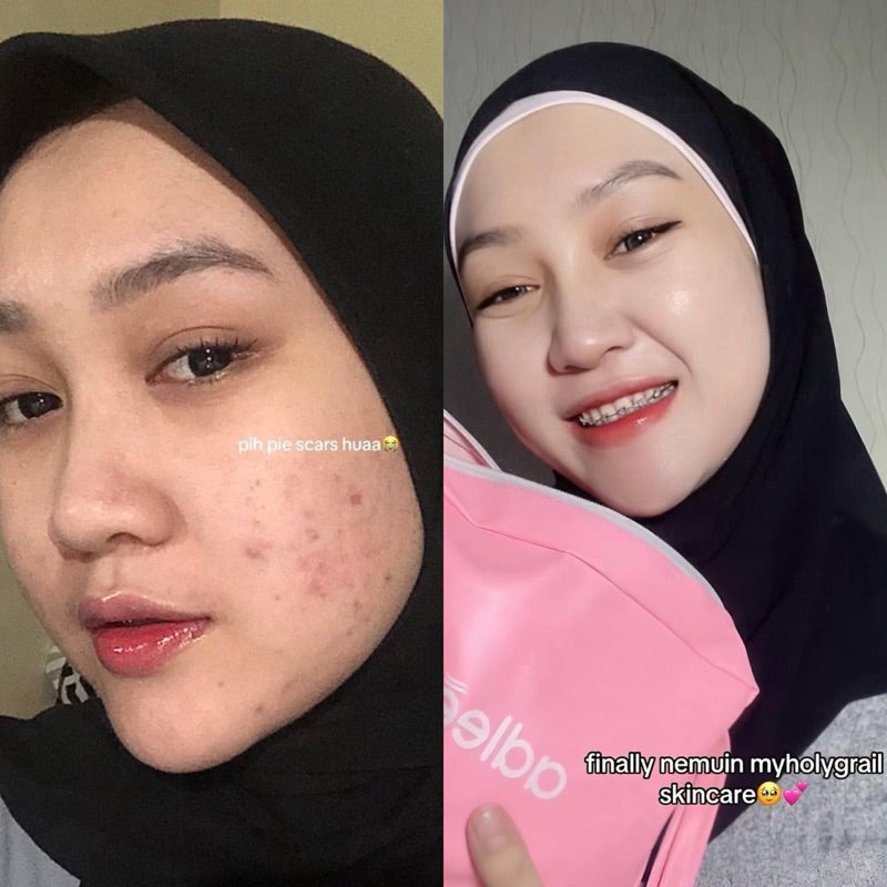 ADLEEVA Paket Hemat Acne Bright Series "COMPLETE" (Paket Isi 5 - Free Acne Blemish Spot)