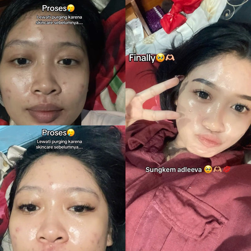 ADLEEVA Night Cream Acne Fighter & Glow Power