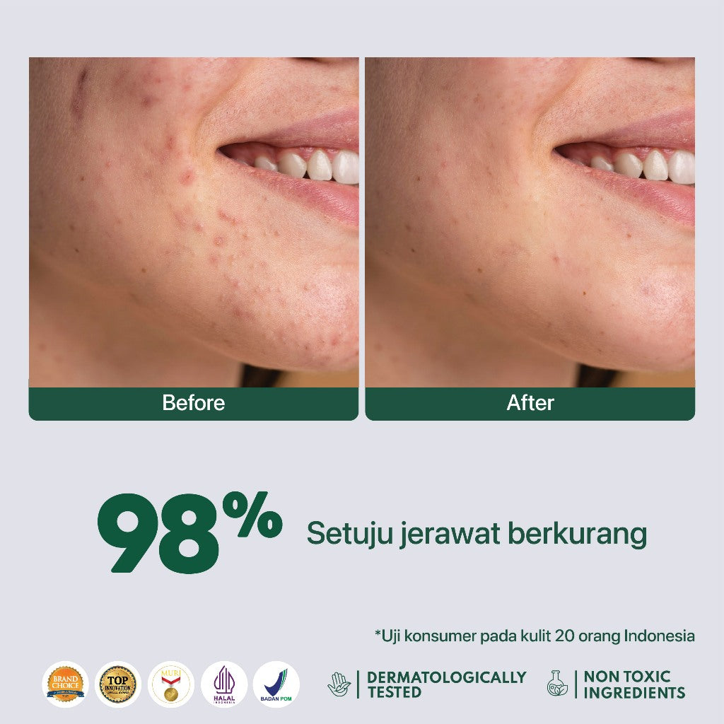 ACNE SPOT - NPURE Spot Treatment Acne Spot / Totol Jerawat