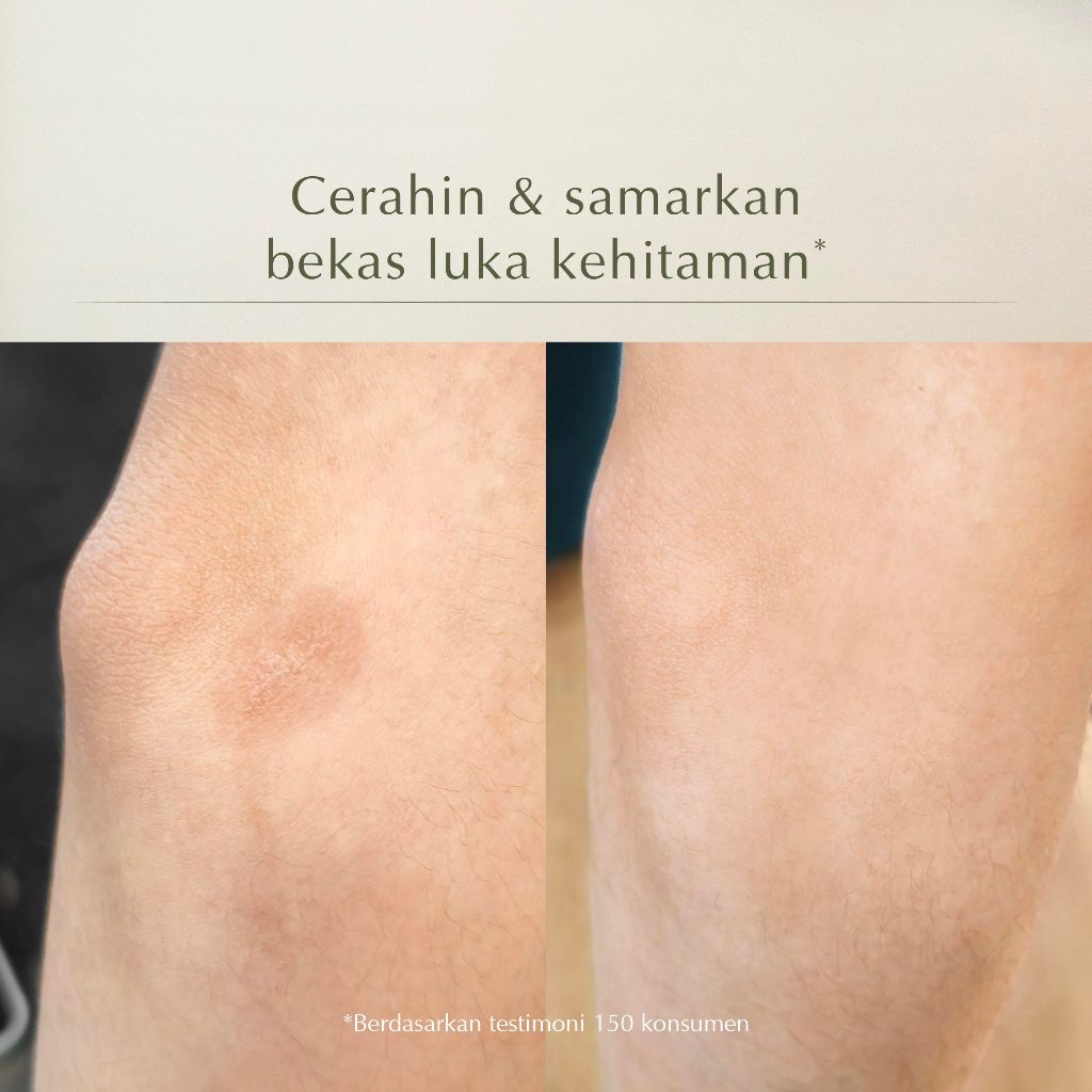 MOSSÈRU 3% Tranexamic Bright Booster Serum | Tranexamic Acid | Niacinamide | Brightening Serum | Menenangkan kulit Kemerahan | Pudarkan Flek & Melasma  | Serum Bekas Jerawat | Menghidrasi kulit | Meratakan warna kulit | Memudarkan bekas je