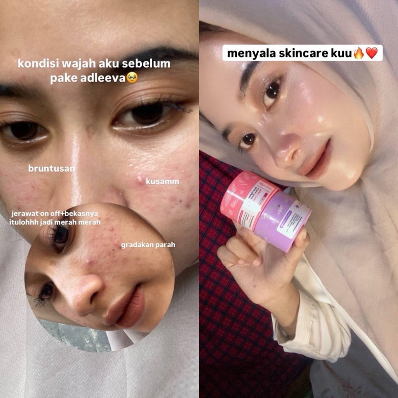 ADLEEVA Paket Hemat Acne Bright Series "COMPLETE" (Paket Isi 5 - Free Acne Blemish Spot)
