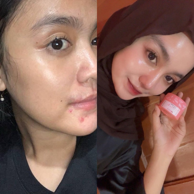 ADLEEVA Paket Hemat Acne Bright Series "COMPLETE" (Paket Isi 5 - Free Acne Blemish Spot)