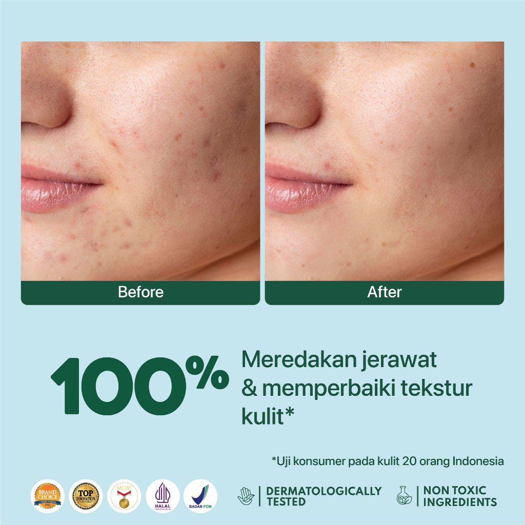 NPURE Anti Acne Serum / Serum Anti Jerawat / Kulit Berminyak / Serum Wajah Bebas Jerawat