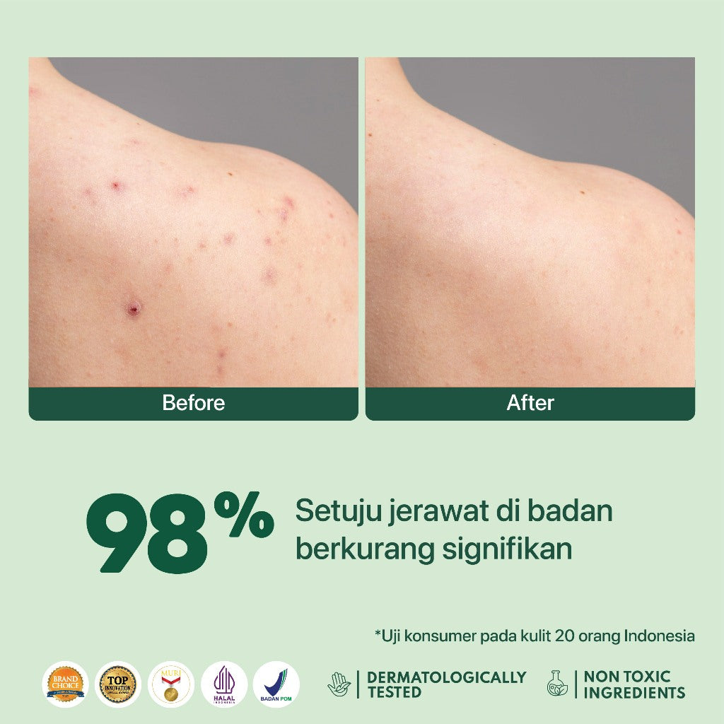 NPURE Bacne Spray /Jerawat Punggung & Badan / Chicken Skin / Keratosis Pilaris / Salicylic Acid 2% / Aman Kulit Sensitif