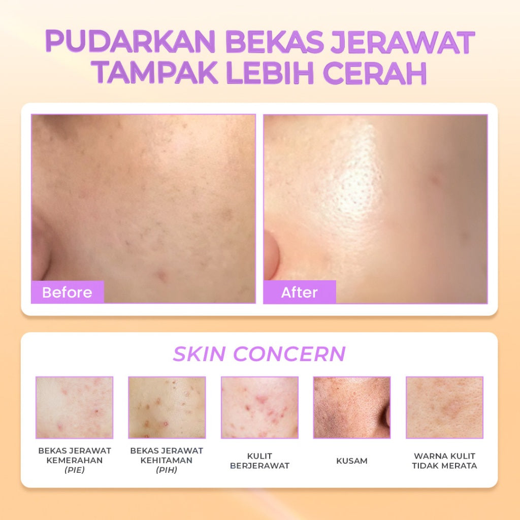 Hanasui Power Post Acne Serum - Pudarkan Bekas Jerawat PIE & PIH Mencerahkan dan Kurangi Kemerahan Cegah Jerawat Kembali