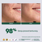 LIVE ONLY - ACNE SPOT - NPURE Spot Treatment Acne Spot / Totol Jerawat