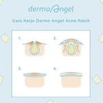 Derma Angel Patch Jerawat Malam 6 pcs