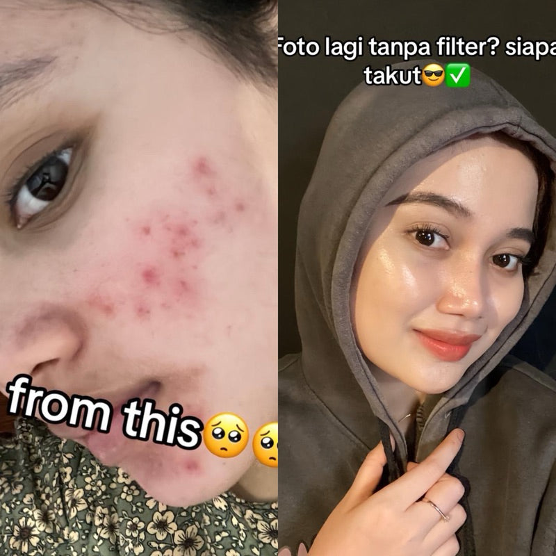 ADLEEVA Acne Fighter Power Serum