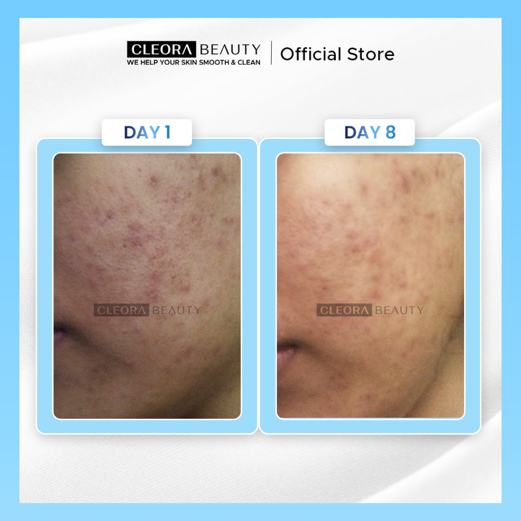 Cleora Special Bundling - Moisturizer Brightening & Acne Spot Gel Pelembab Mencerahkan Obat Totol Jerawat Niacinamide Skin Barrier Untuk Wanita Pria Cream Salep Perawatan Wajah