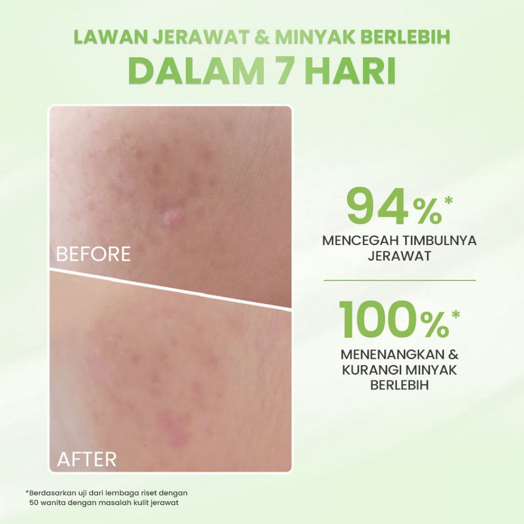 Hanasui Acne Expert Series - Mengurangi Jerawat Menenangkan & Kurangi Minyak berlebih, Salicylic Acid Centella Panthenol