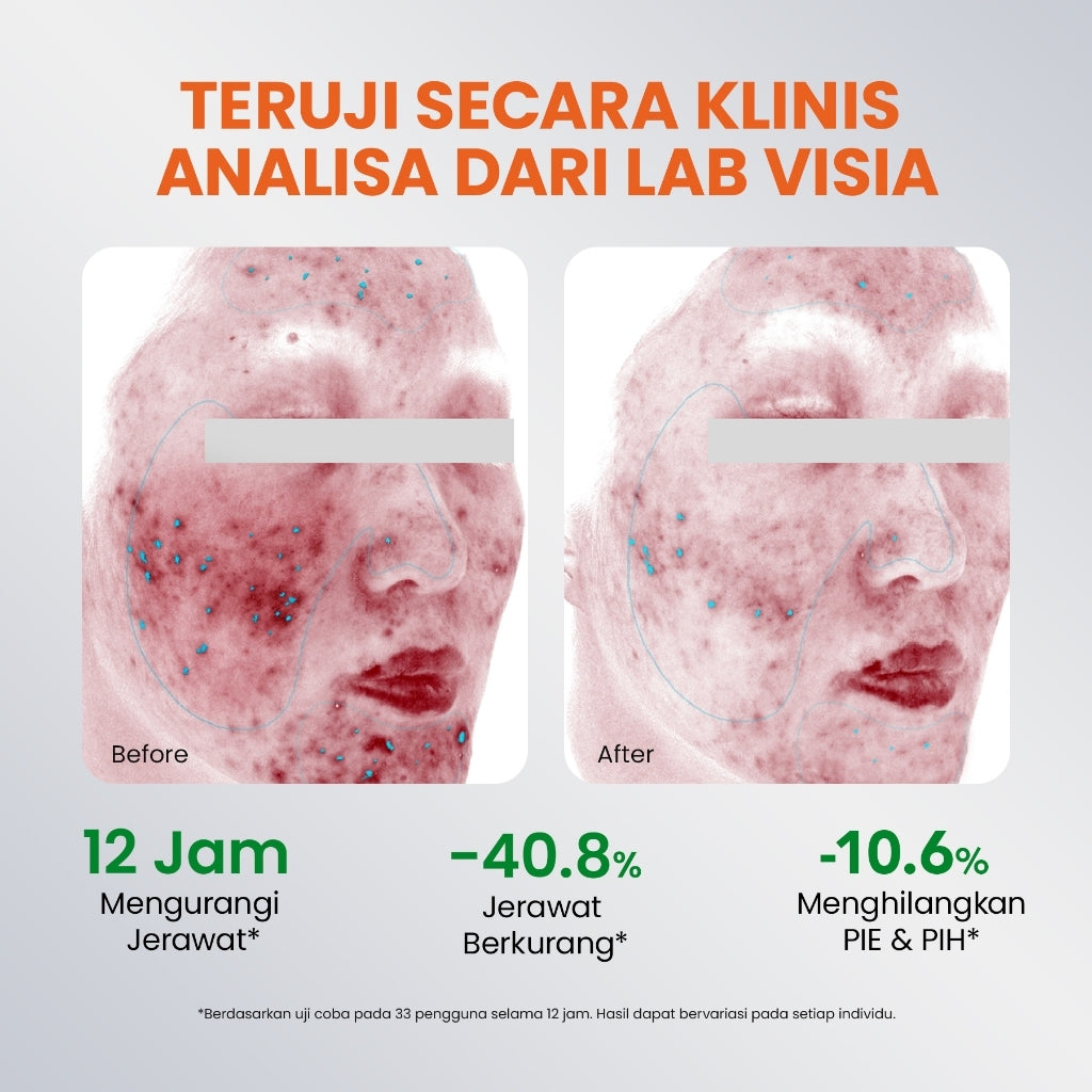 [NEW UPGRADED] YOU AcnePlus Spot Care Pro Serum Obat Totol Jerawat Obat Jerawat Obat Bekas Jerawat